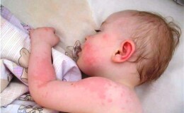 Бывает ли аллергия на цветную капусту у грудничка